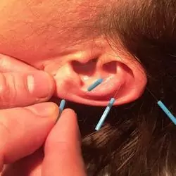 Heilpraktiker für Akupunktur und Ohrakupunktur in Ihrer Nähe in Berlin 🌿 [Charlottenburg-Wilmersdorf]